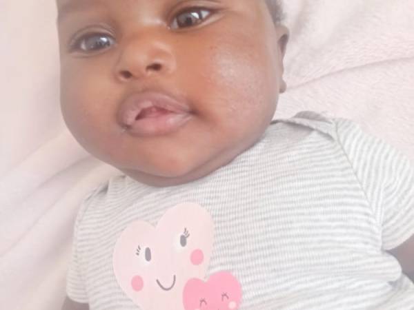 Eczema (Atopic Dermatitis)